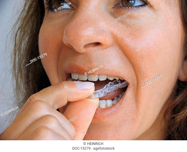 Bruxismus - to step by the crunching with the teeth bruxism - the mostly unconscious nocturnal crunching with the teeth - in most blemish loads cases of the...