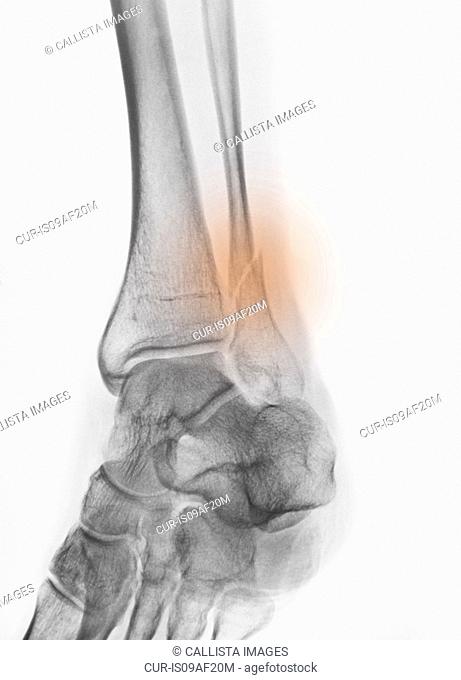 x-ray of a fracture of the distal fibula