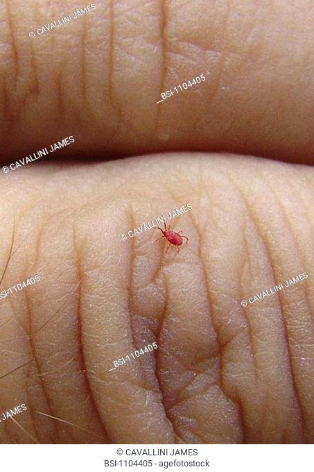 MITE<BR>Chigger on human skin. A chigger is a red mite whose bite causes a benign dermatosis with severe itching