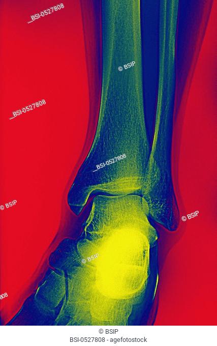 ANKLE, X-RAY
