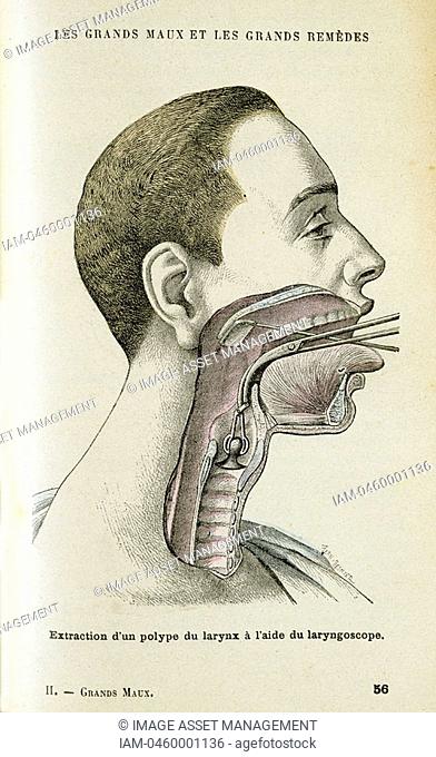 Using a laryngoscope to aid a surgeon in the removal of a polyp from the throat, c1890  A small mirror on a long metal handle was invented in 1854 by a Spanish...