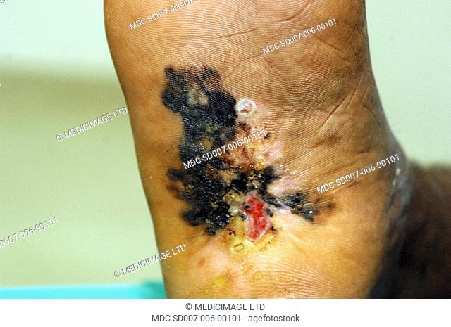 Close-up of a malignant melanoma on the heel of an elderly woman. Melanoma is a malignant tumor of melanocytes pigment producing cells found in the skin
