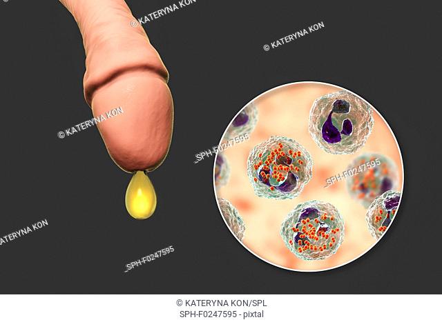 Gonorrhoea infection in male, computer illustration. Gonorrhoea is a sexually transmitted infection caused by the Gram-negative bacteria Neisseria gonorrhoeae