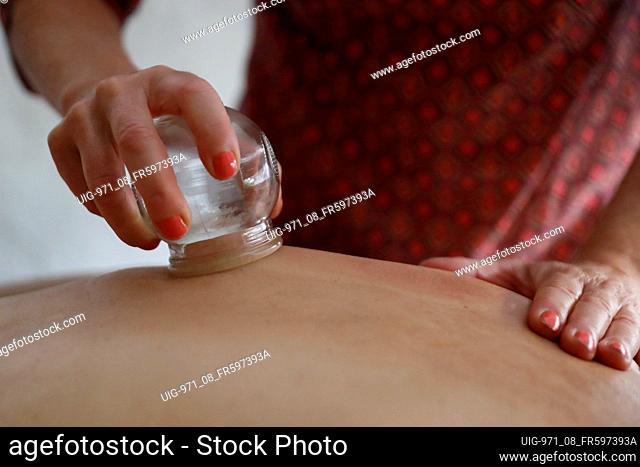 Traditional chinese medecine. Cupping therapy. Woman receving fire cupping. France