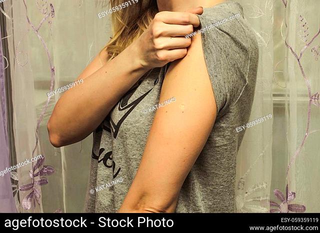 Woman with smallpox following BCG vaccination against TB vaccine on her arm