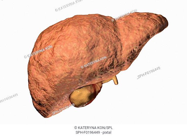 Liver fibrosis, illustration