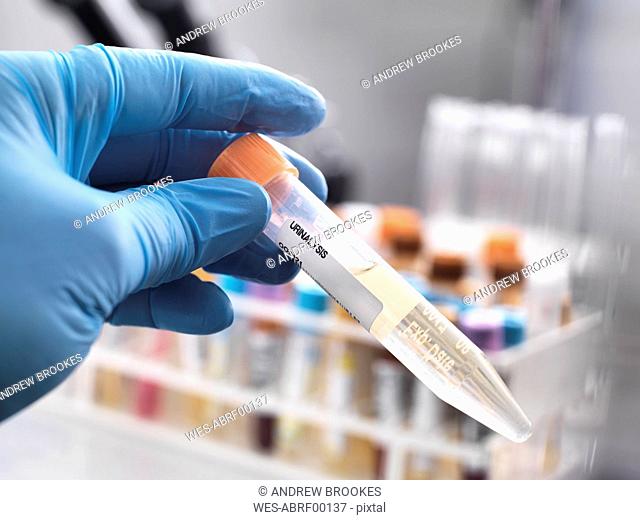 Medical technician preparing a human urine sample for clinical testing