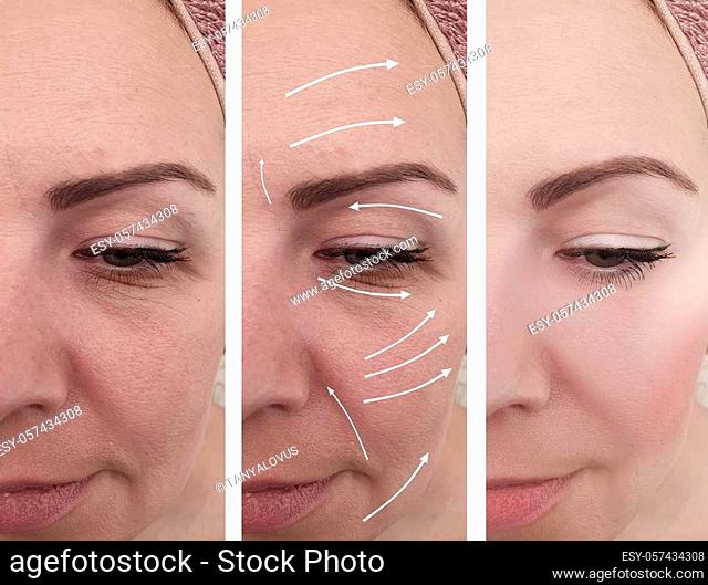 woman wrinkles face before and after collage procedures