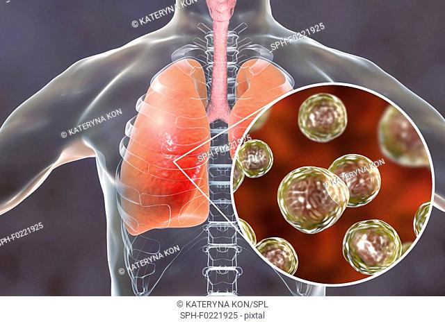 Pulmonary blastomycosis, conceptual illustration