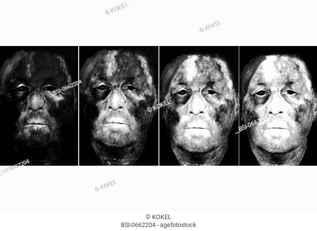 HORTON'S SYNDROME<BR>Horton's syndrome, also known as temporal or giant cell arteritis. Fluorescein angiography of the face