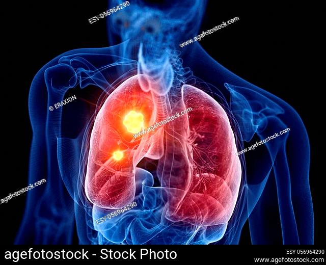 3d rendered medically accurate illustration of lung cancer