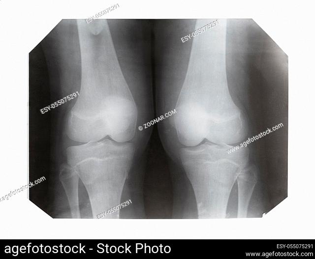 film with X-ray image of front view of two human knees isolated on white background