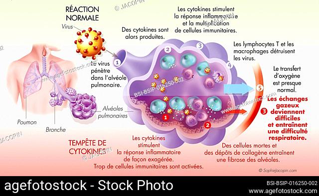 Cytokine storm and inflammatory response localized in the pulmonary alveoli. This medical illustration shows on the upper side the normal immune response when a...