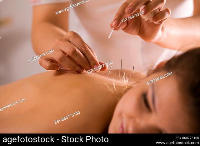 The doctor sticks needles into thegirl's body on the acupuncture, close-up view