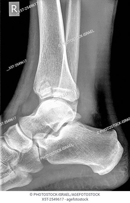 X-ray of an ankle 50 year old male with a fractured tibia. Side View