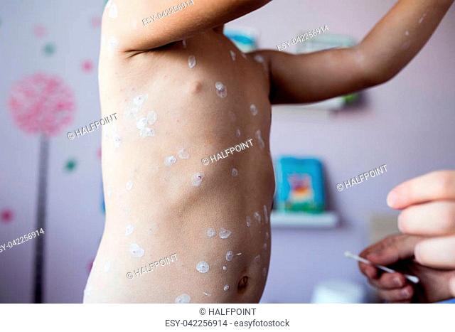 Little two year old girl at home sick with chickenpox, white antiseptic cream applied by her mother to the rash