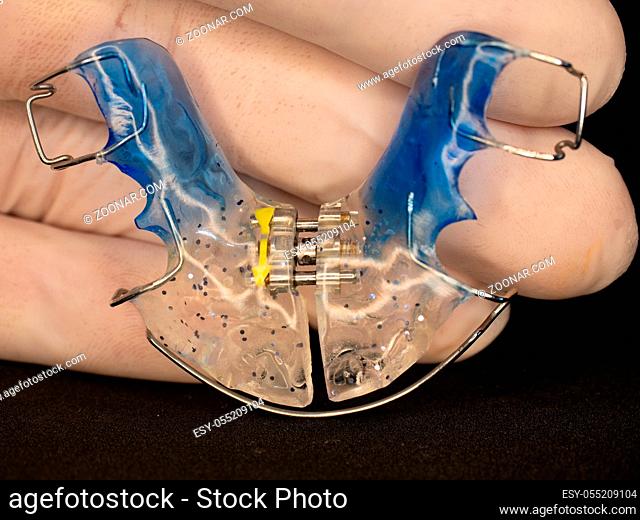 Dentist show Dental Blue Removable Retainer for sleeping. Retainer blue on hand with white rubbery glove