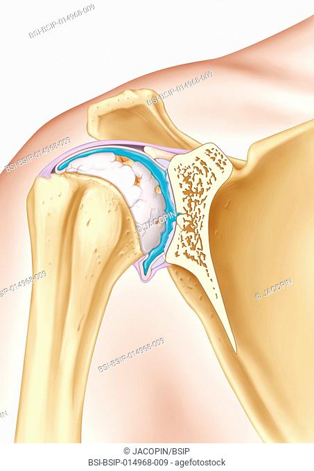 Illustration of the treatment of osteoarthritis in the shoulder, by injecting a viscosupplement (blue) into the synovial joint surrounded by its membrane (pink)