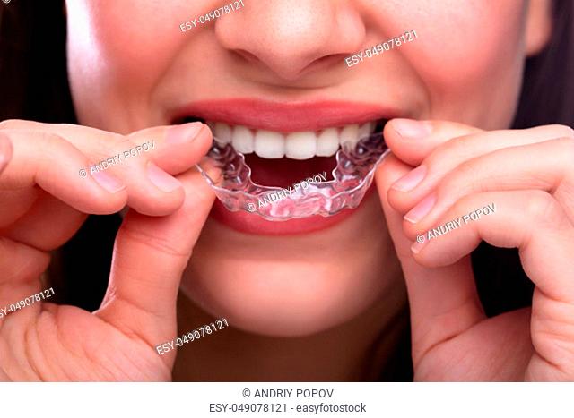 Close-up Of A Woman's Hand Putting Transparent Aligner In Teeth