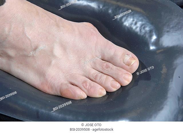 Photo essay from health professional's office. Photo essay in a podiatry surgery. Cares of podiatry. Imprint taking of the feet moulding for making thermoformed...