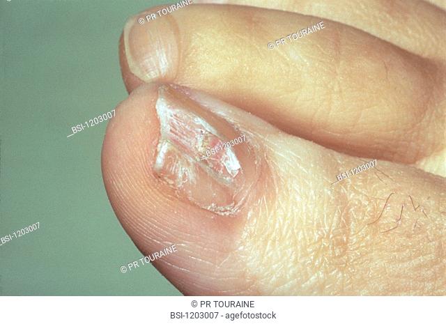 ONYCHOMYCOSIS Onchomycosis mycosis of the great toe nail