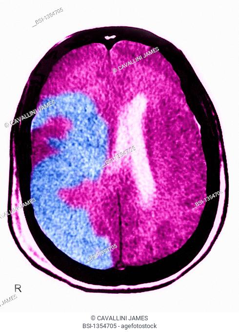 CEREBROVASCULAR ACCIDENT, SCAN<BR>Cerebrovascular accident (CVA) caused by an arterial embolism. Shown here, damage to the right hemisphere of the brain