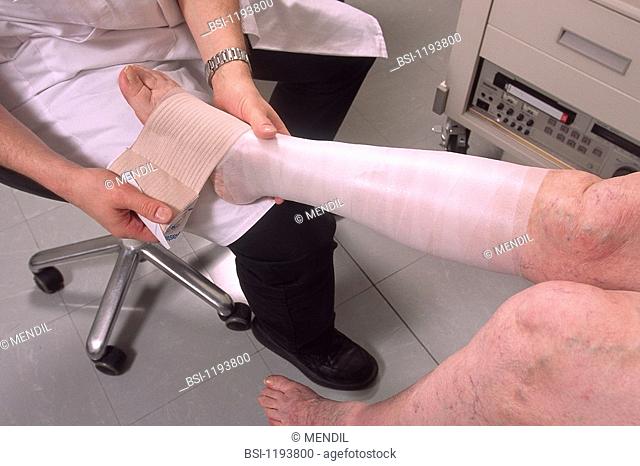 TREATMENT FOR A VARICOSE VEIN<BR>Fixing bandage to fight off blood accumulation in the legs and prevent phlebitis or ulcer