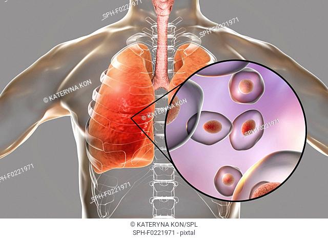 Pneumocystis pneumonia, conceptual illustration