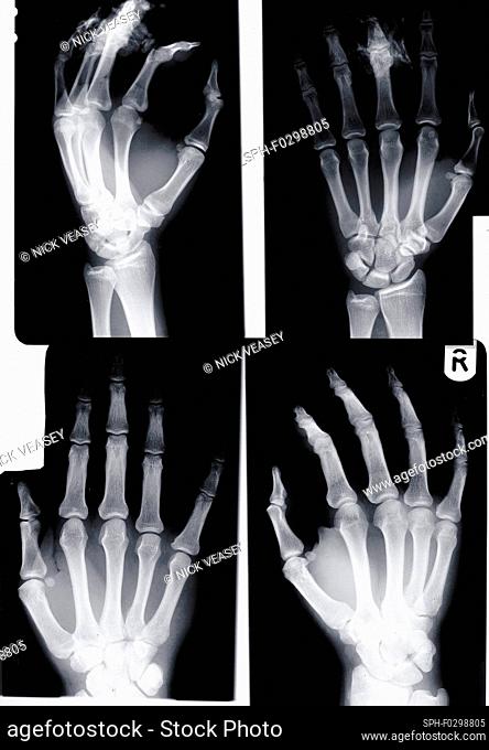 Four human hands, X-ray