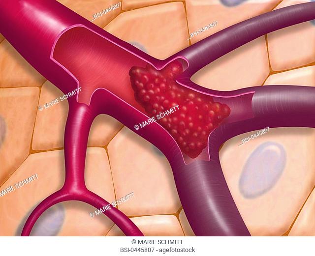 ARTERIAL THROMBOSIS, DRAWING Thrombus at the level of a pulmonary arteriole : a clot that obstruct blood circulation, that may be the cause of embolism