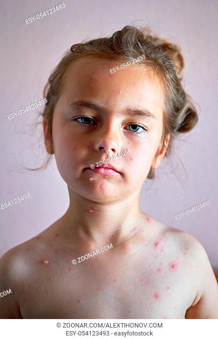 Portrait of a lovely 6 years old little girl with chickenpox