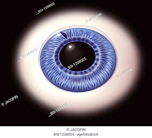 <BR>Glaucoma - laser iridectomy.  Illustration of a frontal view of an iridectomy: a laser is used to cut a small hole in the iris in order to allow the aqueous...