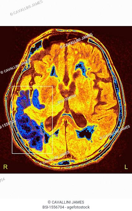 CEREBROVASCULAR ACCIDENT, SCAN<BR>Stroke due to arterial thrombosis in right hemisphere. CT scan of brain, axial view