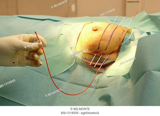 CURIETHERAPY<BR>Photo essay from hospital.<BR>Brachytherapy at the Hôpital Saint Louis in Paris. Brachytherapy is one type of treatment for breast cancer