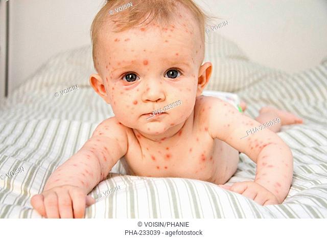 Chickenpox on a 4 months old baby