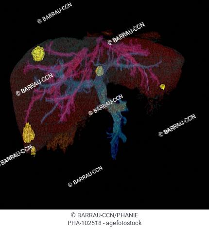 Three-dimensional computed tomographic reconstruction scan of the liver showing metastasis yellow from a primary colorectal cancer