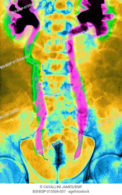X-ray of urinary schistosomiasis. Frontal abdominal-pelvic x-ray