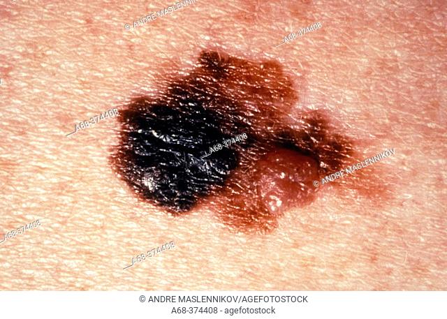 Skin cancer: malign melanoma on arm