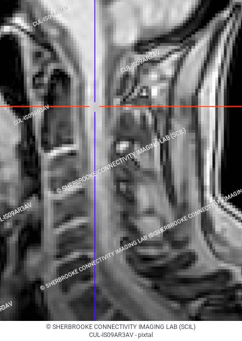 Spinal cord of a healthy control. Anatomical T1 weighted image