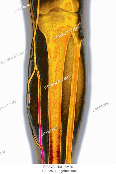 LOWER LIMB ANGIOGRAPHY Healthy great saphenous vein long saphenous vein, visualized by phlebography of the leg in front view