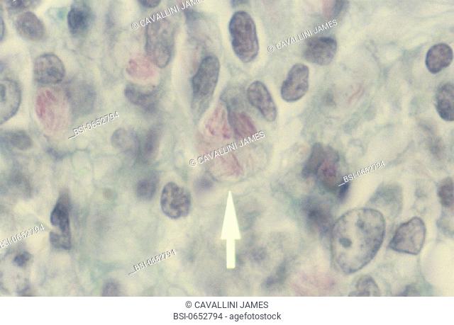 LEPROSY<BR>Lepromatous Leprosy (LL). Hansen's Bacillus. Magnification: 1000x