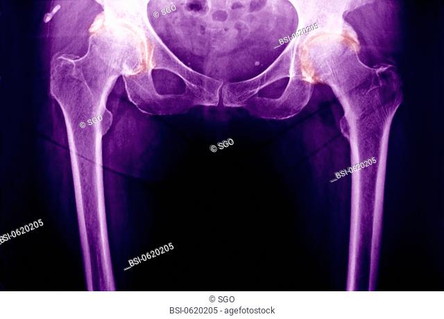 ARTHROSIS OF THE HIP, X-RAY<BR>Degenerative arthritis is an articular ailment characterized by degenerative lesions along with proliferation of bone tissue