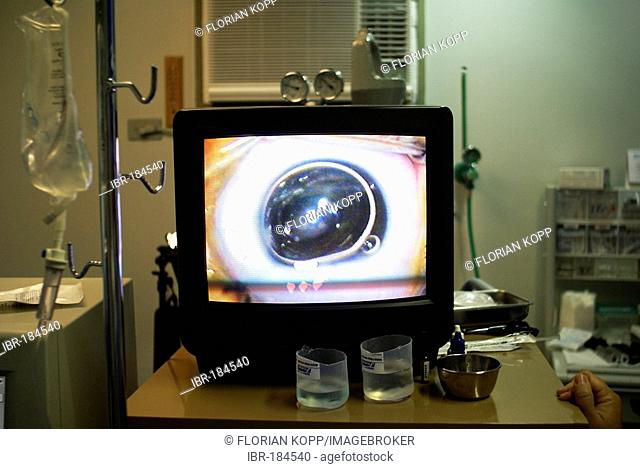 Eye surgery (Cataract) on a monitore in the surgery room, Recife, Brazil