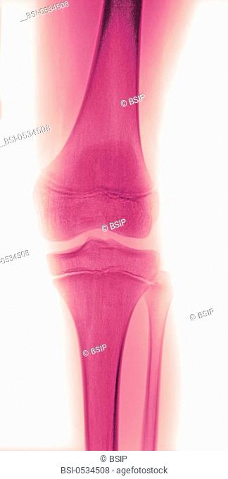 Epiphyseal cartilage of the femur and tibia, in light pink. This cartilage plays a vital role during bone growth. X-ray image of a 12-year-old girl's knee