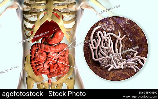 Parasitic worms in human small intestine, 3D illustration. Ascaris lumbricoides and other round worms