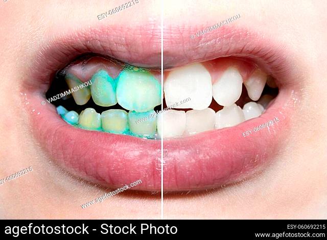 Baby mouthwash. Dental plaque. Teeth. Teeth before and after brushing and whitening in one photo. Dental hygiene