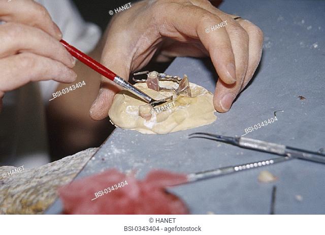 DENTURE FITTER<BR>Photo essay.<BR>Prosthetist. Gluing with resin : liquid resin, before polymerization, is used for all repairs and additions