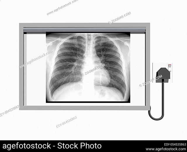 Röntgen Betrachter mit Brustkoprb im Röntgenbild