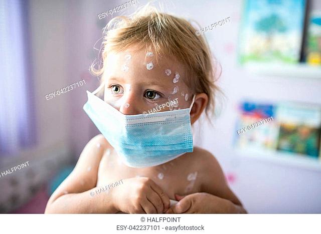 Little two year old girl at home sick with chickenpox, white antiseptic cream applied to the rash