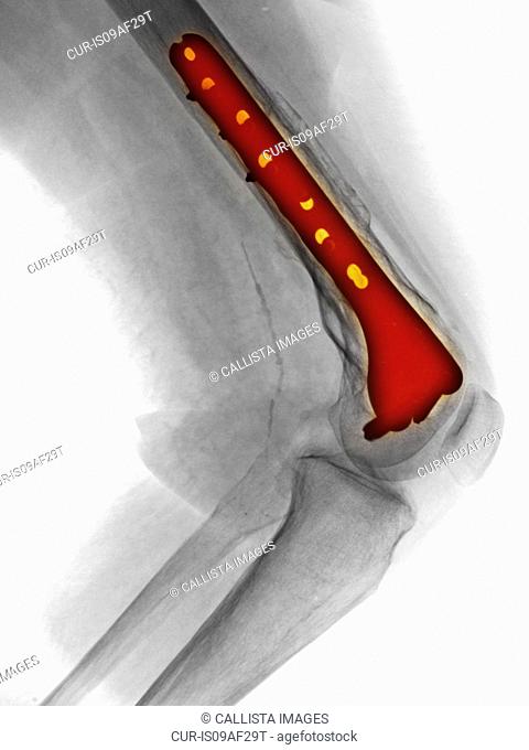 X-ray of leg showing fracture of the femur